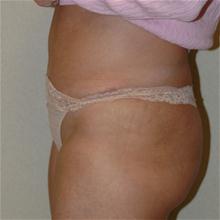 Tummy Tuck After Photo by Eric Emerson, MD; Gastonia, NC - Case 27273