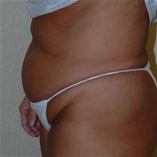 Tummy Tuck Before Photo by Eric Emerson, MD; Gastonia, NC - Case 27273