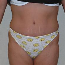 Tummy Tuck After Photo by Eric Emerson, MD; Gastonia, NC - Case 27274