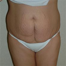 Tummy Tuck Before Photo by Eric Emerson, MD; Gastonia, NC - Case 27274