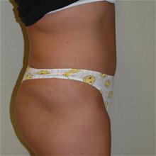 Tummy Tuck After Photo by Eric Emerson, MD; Gastonia, NC - Case 27274