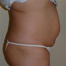 Tummy Tuck Before Photo by Eric Emerson, MD; Gastonia, NC - Case 27274