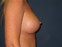 Breast Augmentation After Photo by Stephen Greenberg, MD; Woodbury, NY - Case 29048