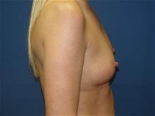 Breast Augmentation Before Photo by Stephen Greenberg, MD; Woodbury, NY - Case 29048