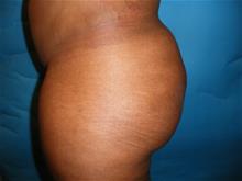 Buttock Lift with Augmentation After Photo by Stephen Greenberg, MD; Woodbury, NY - Case 29049