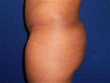 Buttock Lift with Augmentation Before Photo by Stephen Greenberg, MD; Woodbury, NY - Case 29049