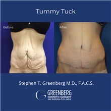 Tummy Tuck Before Photo by Stephen Greenberg, MD; Woodbury, NY - Case 50478