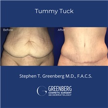 Tummy Tuck After Photo by Stephen Greenberg, MD; Woodbury, NY - Case 50479