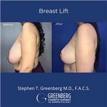 Breast Reduction Before Photo by Stephen Greenberg, MD; Woodbury, NY - Case 50473