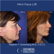 Facelift After Photo by Stephen Greenberg, MD; Woodbury, NY - Case 50475