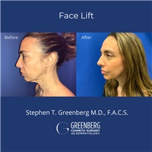Facelift Before Photo by Stephen Greenberg, MD; Woodbury, NY - Case 50477