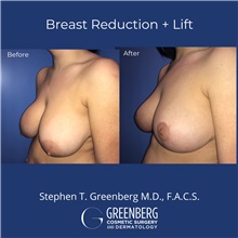 Breast Reduction Before Photo by Stephen Greenberg, MD; Woodbury, NY - Case 50472