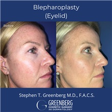 Eyelid Surgery Before Photo by Stephen Greenberg, MD; Woodbury, NY - Case 50474
