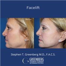 Facelift After Photo by Stephen Greenberg, MD; Woodbury, NY - Case 50476