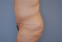 Tummy Tuck After Photo by Raymond Mockler, MD; Panama City, FL - Case 10344