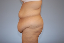 Tummy Tuck Before Photo by Raymond Mockler, MD; Panama City, FL - Case 10344