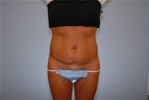 Tummy Tuck Before Photo by Raymond Mockler, MD; Panama City, FL - Case 22784