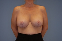 Breast Lift After Photo by Raymond Mockler, MD; Panama City, FL - Case 22785