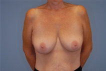 Breast Lift Before Photo by Raymond Mockler, MD; Panama City, FL - Case 22785