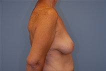Breast Lift Before Photo by Raymond Mockler, MD; Panama City, FL - Case 22785
