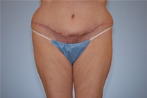 Tummy Tuck After Photo by Raymond Mockler, MD; Panama City, FL - Case 22786