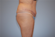 Tummy Tuck After Photo by Raymond Mockler, MD; Panama City, FL - Case 22786