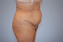 Tummy Tuck Before Photo by Raymond Mockler, MD; Panama City, FL - Case 22786