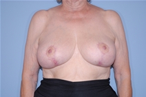 Breast Lift After Photo by Raymond Mockler, MD; Panama City, FL - Case 22787