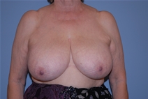 Breast Lift Before Photo by Raymond Mockler, MD; Panama City, FL - Case 22787