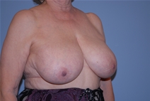 Breast Lift Before Photo by Raymond Mockler, MD; Panama City, FL - Case 22787