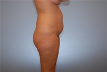 Tummy Tuck Before Photo by Raymond Mockler, MD; Panama City, FL - Case 22838