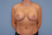 Breast Augmentation After Photo by Raymond Mockler, MD; Panama City, FL - Case 22839