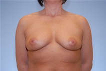 Breast Augmentation Before Photo by Raymond Mockler, MD; Panama City, FL - Case 22839