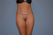 Tummy Tuck After Photo by Raymond Mockler, MD; Panama City, FL - Case 22840