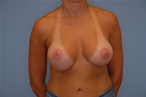 Breast Augmentation After Photo by Raymond Mockler, MD; Panama City, FL - Case 22841