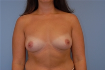 Breast Augmentation Before Photo by Raymond Mockler, MD; Panama City, FL - Case 22929