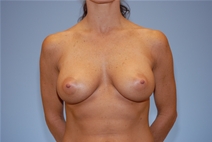 Breast Augmentation After Photo by Raymond Mockler, MD; Panama City, FL - Case 22930