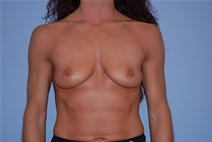 Breast Augmentation Before Photo by Raymond Mockler, MD; Panama City, FL - Case 22930
