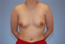 Breast Augmentation Before Photo by Raymond Mockler, MD; Panama City, FL - Case 22931