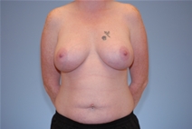 Breast Augmentation After Photo by Raymond Mockler, MD; Panama City, FL - Case 22933