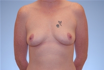 Breast Augmentation Before Photo by Raymond Mockler, MD; Panama City, FL - Case 22933