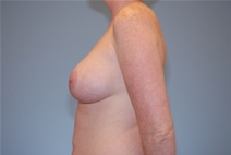 Breast Augmentation After Photo by Raymond Mockler, MD; Panama City, FL - Case 22933