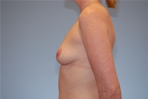 Breast Augmentation Before Photo by Raymond Mockler, MD; Panama City, FL - Case 22933