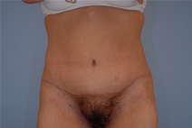 Tummy Tuck After Photo by Raymond Mockler, MD; Panama City, FL - Case 22934