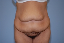 Tummy Tuck Before Photo by Raymond Mockler, MD; Panama City, FL - Case 22934