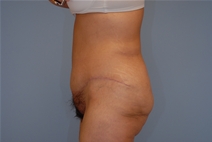 Tummy Tuck After Photo by Raymond Mockler, MD; Panama City, FL - Case 22934