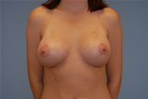 Breast Augmentation After Photo by Raymond Mockler, MD; Panama City, FL - Case 22956