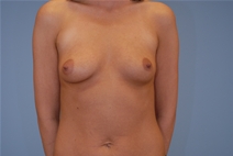 Breast Augmentation Before Photo by Raymond Mockler, MD; Panama City, FL - Case 22956