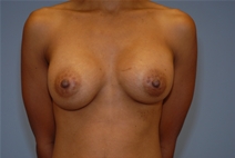 Breast Augmentation After Photo by Raymond Mockler, MD; Panama City, FL - Case 23196