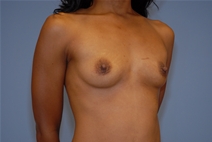 Breast Augmentation Before Photo by Raymond Mockler, MD; Panama City, FL - Case 23196